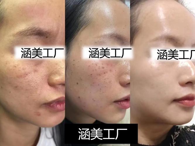 院祛斑祛痘产品加盟代理,定制自己的祛斑祛痘化妆品我们是源头工厂